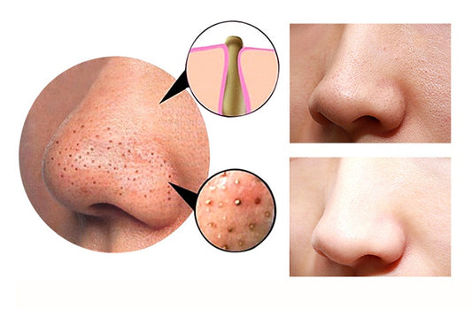 Before and after comparison of a nose with skin treatment showing pores and texture.